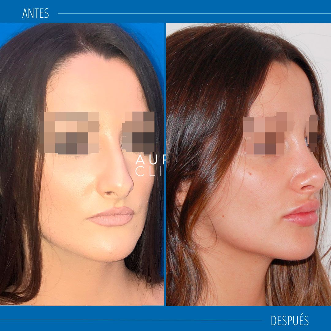 Rinoplastia ultrasonica Sevilla
