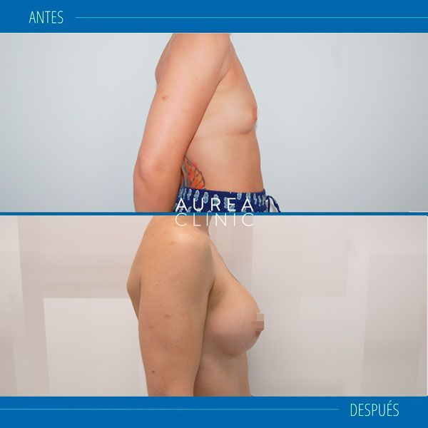 aumento de pecho en Aurea Clinic Sevilla