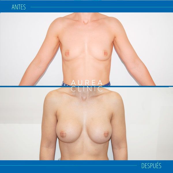 aumento de pecho en Aurea Clinic Sevilla