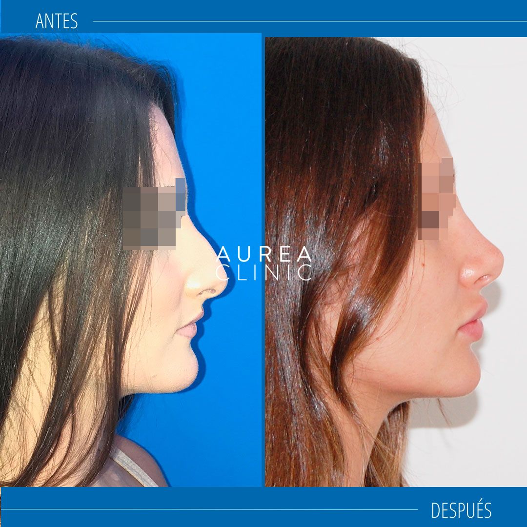 Rinoplastia ultrasonica Sevilla antes y después