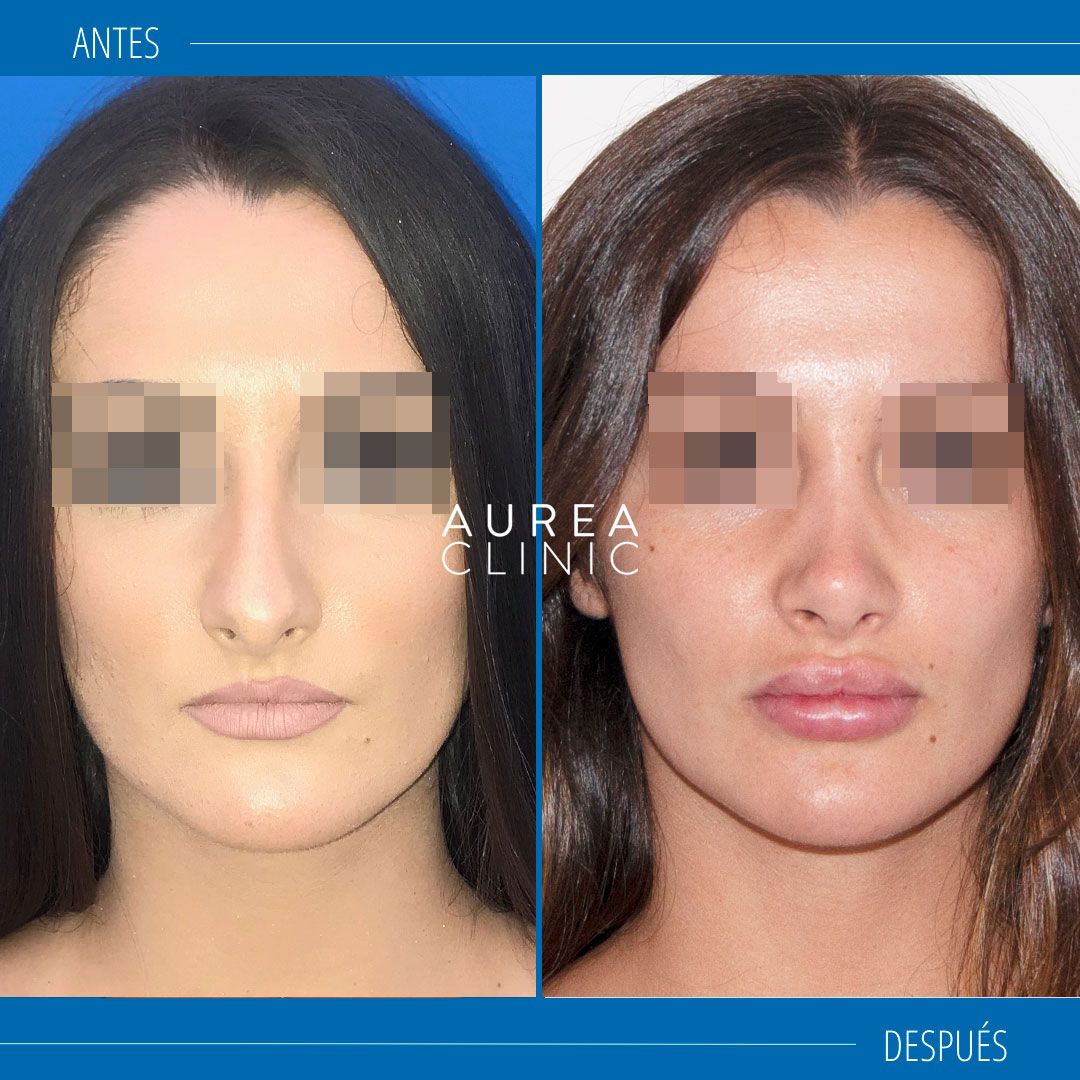 Rinoplastia ultrasonica Sevilla Dra Martinez Padilla