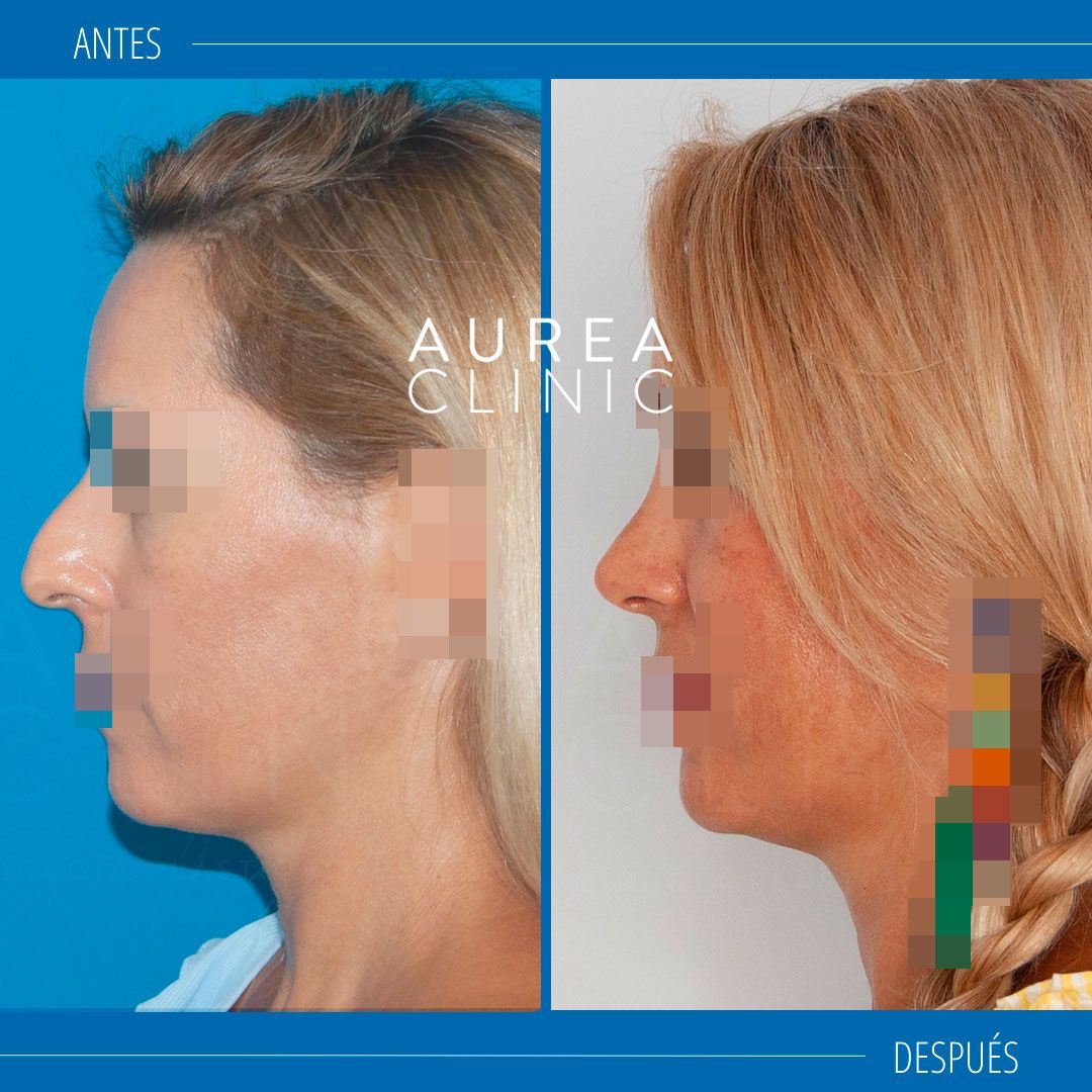 Mejor cirujano rinoplastia ultrasónica