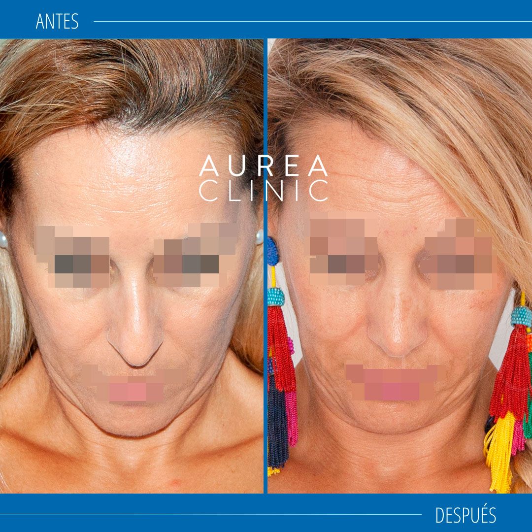 Mejor cirujano rinoplastia antes y después