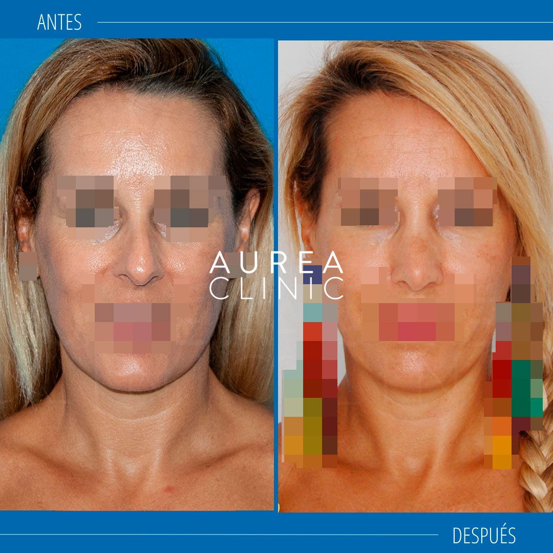 Mejor rinoplastia antes y después