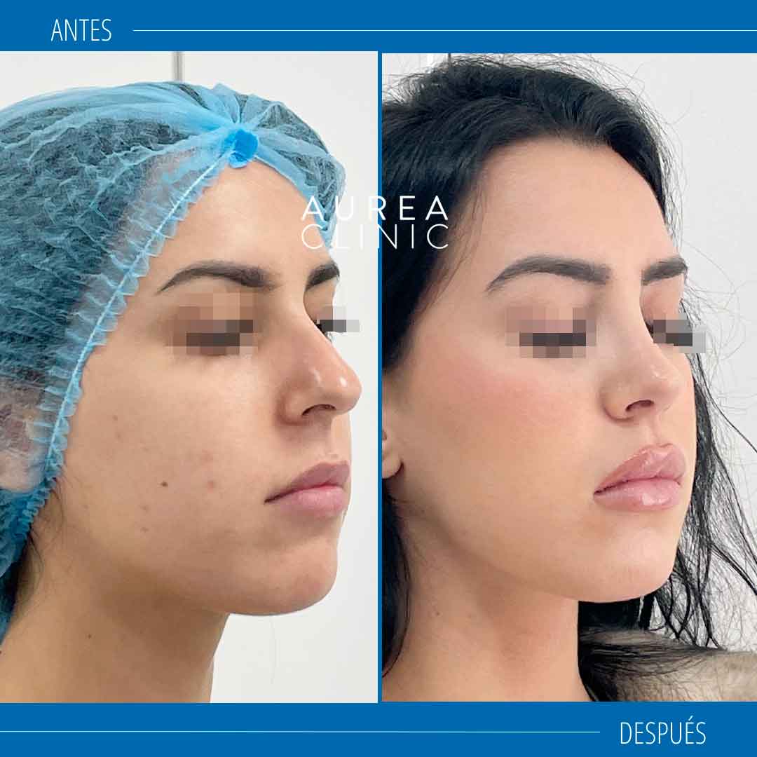 fotos-rinoplastia antes y después