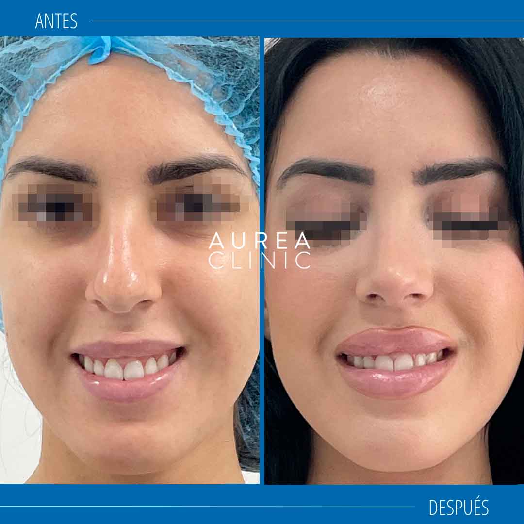 fotos rinoplastia