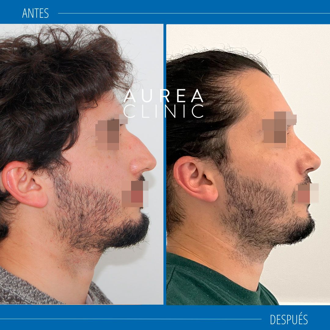 perfil de rinoplastia masculina antes y después