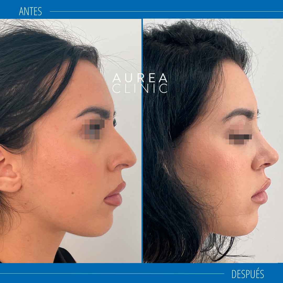 rinoplastia antes y después