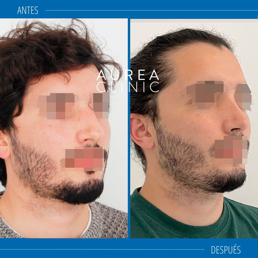 rinoplastia hombres antes después