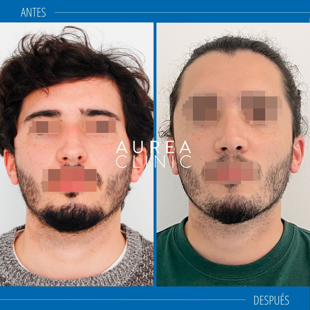rinoplastia masculina antes y después
