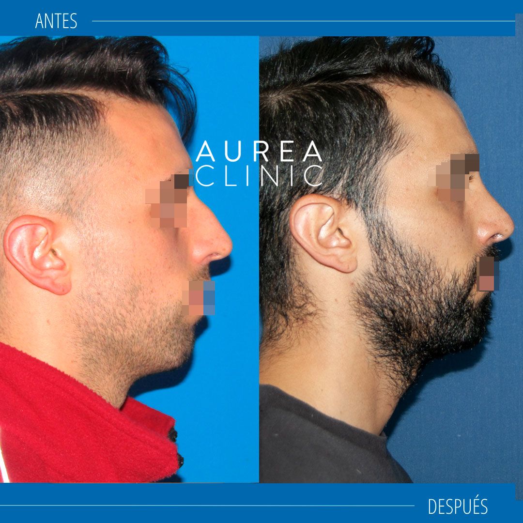 rinoplastia masculina antes y después hombres