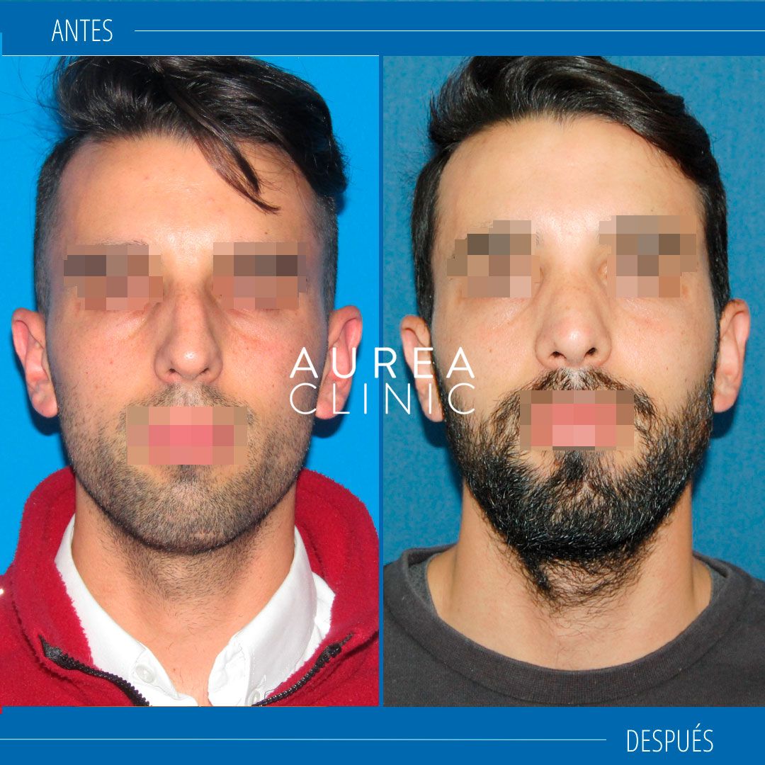 rinoplastia masculina antes y después