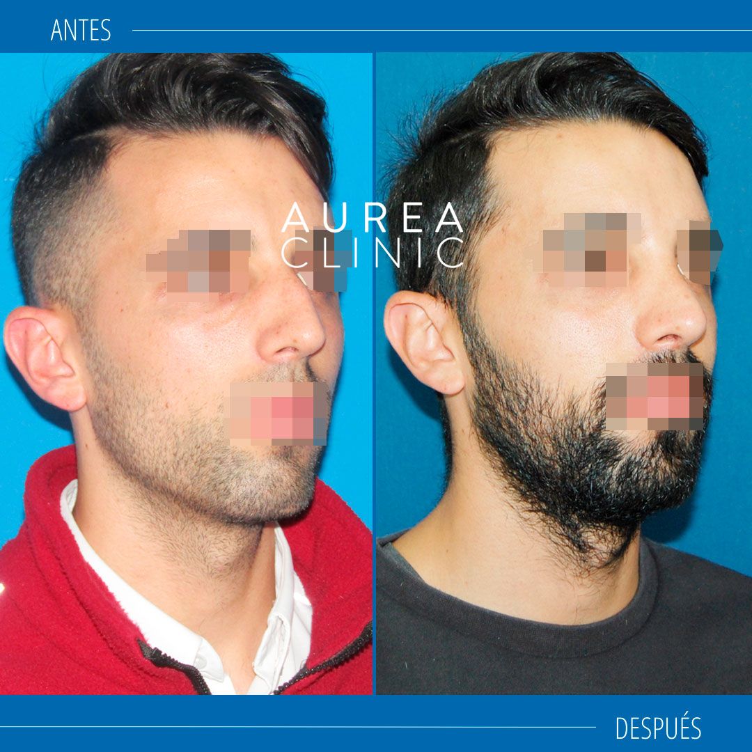 rinoplastia masculina fotos antes y despues
