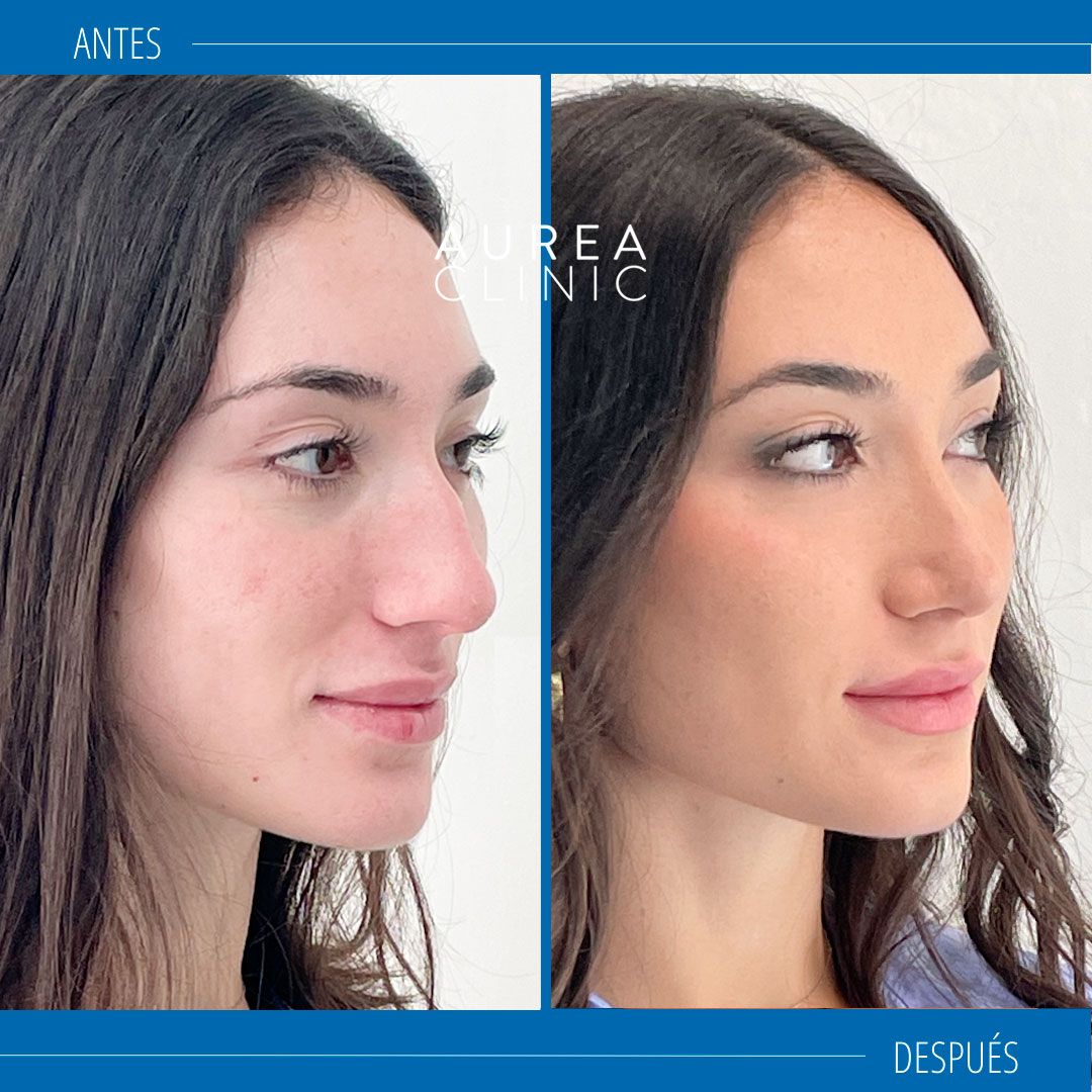 rinoplastia ultrasonica antes y después lateral