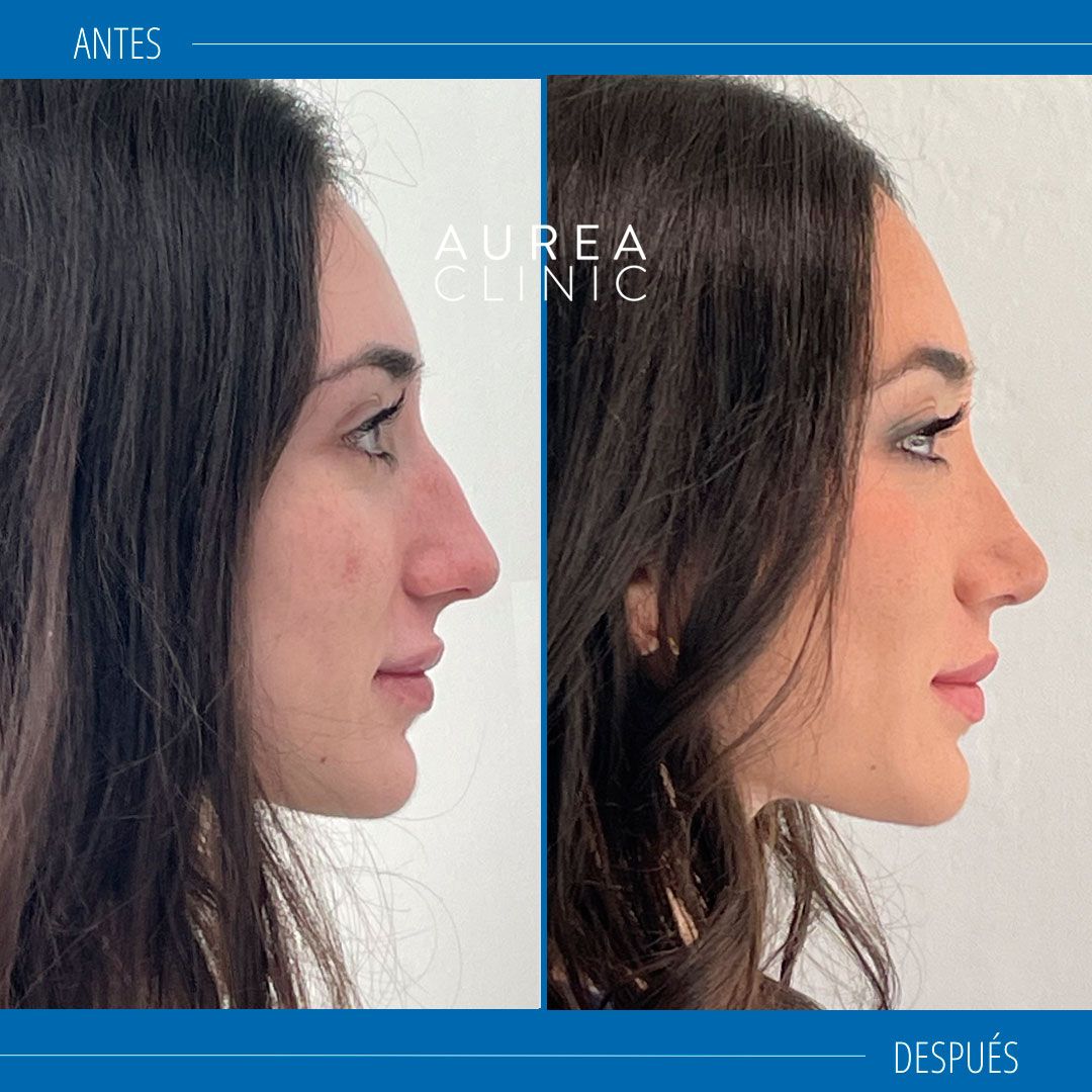 rinoplastia ultrasonica antes y después perfil