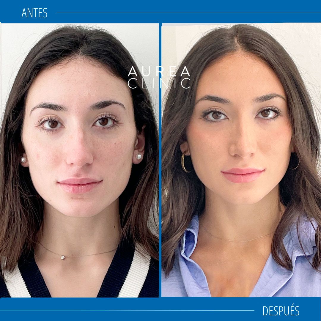rinoplastia ultrasonia antes y después