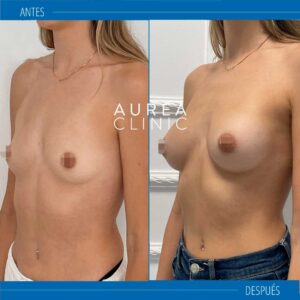 antes y depués fotos mia femtech