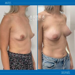 antes y después Mia Femtech