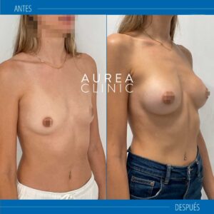 antes y después mia femtech fotos