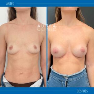 aumento de pecho axila antes y despues mia femtech